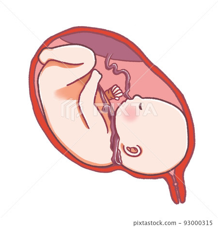 臍帶纏繞 臍帶繞在脖子上的嬰兒 93000315