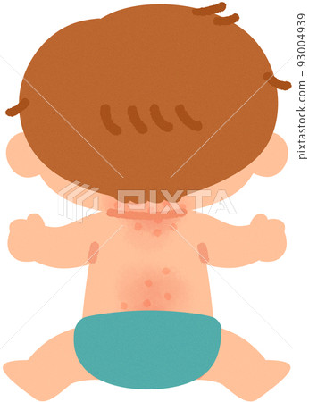 Baby with heat rash (rear side) - Stock Illustration [93004939] - PIXTA