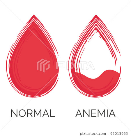 Normal and anemic drop of blood. Lack of red cells, anemia. Isolated on white background. Vector illustration 93015963