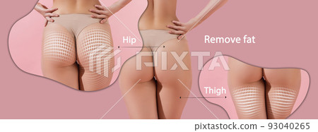 Poster with perfect female buttocks with lifting arrows grid over pink background. Collage. Poster with perfect female buttocks with lifting arrows grid over pink background. Collage. 93040265