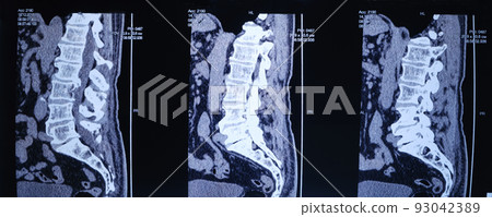 CT image of the spine of a patient with scoliosis and protrusion of the intervertebral disc. 93042389