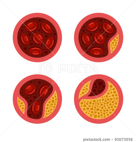 Atherosclerosis. Cholesterol in Blood Vessels Set. Vector 93073056
