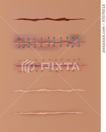 Healing wounds set, skin scars, stitched gash and cuts. Realistic surgical sutures, stitched wounds at different healing stages on human skin background Healing wounds set, skin scars, stitched gash and cuts. Realistic surgical sutures, stitched wounds at different healing stages on human skin background 93076018