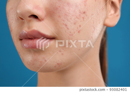 Teenage girl with acne problem on blue background, closeup Teenage girl with acne problem on blue background, closeup 93082401