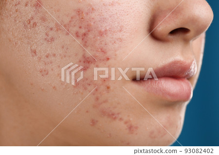 Teenage girl with acne problem on blue background, closeup 93082402