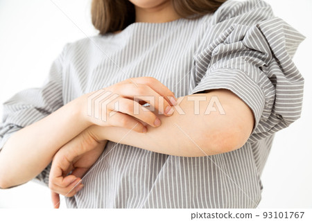 特應性年輕女子抓撓她的手臂 93101767