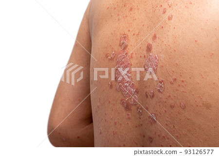 Psoriasis is that back on white background. 93126577