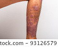 Psoriasis is that knee on white background. 93126579