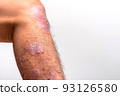 Psoriasis is that knee on white background. 93126580