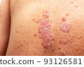 Psoriasis is that back on white background. 93126581