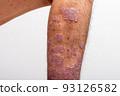 Psoriasis is that knee on white background. 93126582