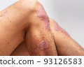 Psoriasis is that knee on white background. 93126583