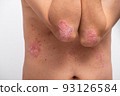 Psoriasis is that elbow on white background. 93126584