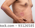 Psoriasis is the abdomen on white background. 93126585