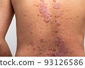 Psoriasis is that back on white background. 93126586