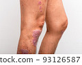 Psoriasis is that knee on white background. 93126587