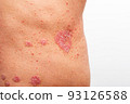 Psoriasis is that back on white background. 93126588