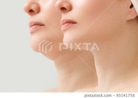 A close portrait of an aged woman before and after the facelift procedure. The result of facial rejuvenation and wrinkle smoothing in a cosmetology clinic. A close portrait of an aged woman before and after the facelift procedure. The result of facial rejuvenation and wrinkle smoothing in a cosmetology clinic. 93141758