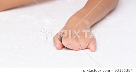 Disabled person hand without fingers since childhood brith, no thumb nail on white background isolated. Woman hands handicap show gesture look disability with arm and surgery wound to split finger 93155394