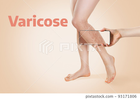 Woman's beautiful legs with varicose veins on the lower leg, which was determined using online diagnostics on the smartphone app. Beige background. Concept of varicose veins and modern treatment Woman's beautiful legs with varicose veins on the lower leg, which was determined using online diagnostics on the smartphone app. Beige background. Concept of varicose veins and modern treatment 93171806