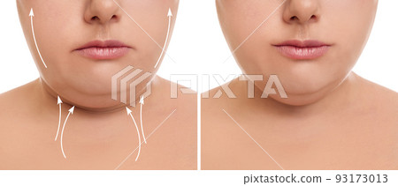 Woman before and after plastic surgery operation on white background, closeup. Double chin problem Woman before and after plastic surgery operation on white background, closeup. Double chin problem 93173013