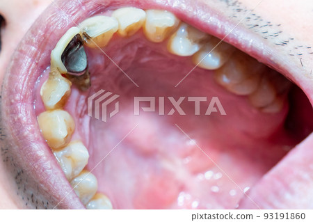根管齲齒照片。一張牙齒露出根部的照片。可怕的蛀牙。 93191860