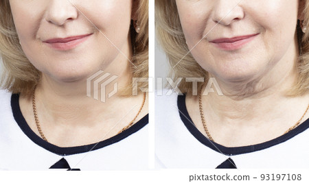 Part of the face of an elderly woman before and after cosmetic procedures.Elderly woman face wrinkles before and after procedures 93197108