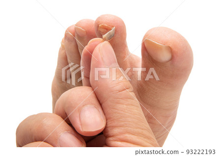 Injured toenail Injured toenail 93222193