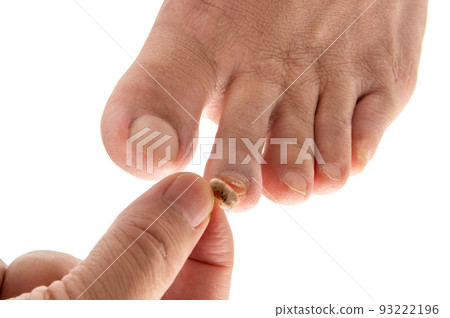 受傷的腳趾甲 受傷的腳趾甲 93222196