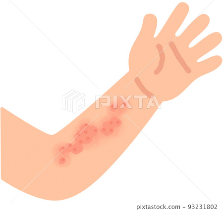 arm with hives 93231802