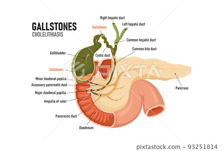 Cholelithiasis. Formations in the gallbladder. Blockage of the bile duct. Pancreas. 93251814