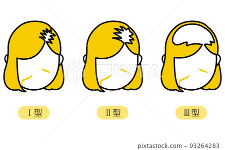 女性 AGA,頭髮稀疏,路德維希分類 I 型,II 型,III 型 女性 AGA,頭髮稀疏,路德維希分類 I 型,II 型,III 型 93264283