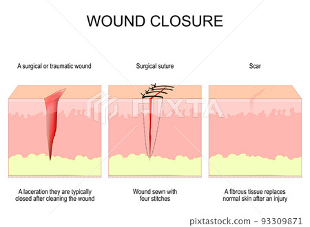 Wound closure. From surgical or traumatic wound to suture and scar. 93309871
