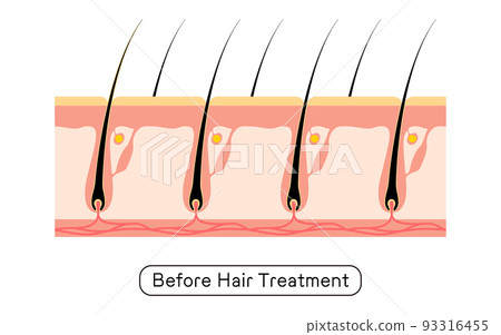 Image of hair removal, before and after hair treatment 93316455