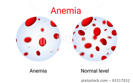 Anemia problem circulatory iron body diagram background. Anaemia biology blood isolated medical 93317832