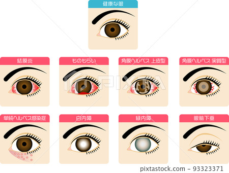 眼疾的圖解材料 93323371