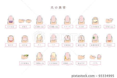 Illustration of nail abnormality / disease Illustration of nail abnormality / disease 93334995