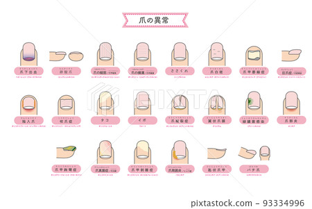 Illustration of nail abnormality / disease 93334996