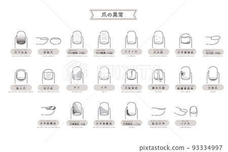 Illustration of nail abnormality / disease 93334997