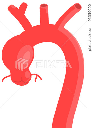 ascending aortic aneurysm - Stock Illustration [93359000] - PIXTA