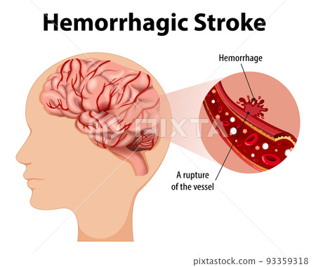 Human with Hemorrhagic stroke Human with Hemorrhagic stroke 93359318