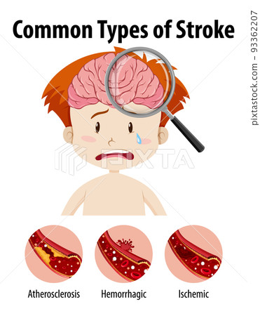 Human with common types of stroke 93362207
