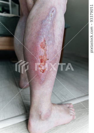 Large healing wound on the lower leg with scars, redness, scarring of the skin, the concept of human tissue regeneration. 93379051
