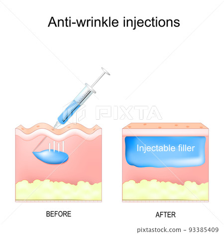 Anti-wrinkle injections. aesthetic procedure. Anti-wrinkle injections. aesthetic procedure. 93385409