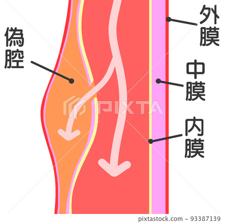 acute aortic dissection acute aortic dissection 93387139