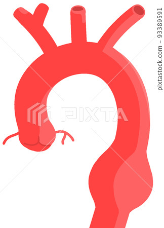 降主動脈瘤 93389591