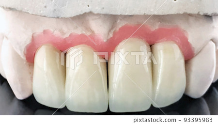 Ceramic dental bridge on plaster model. Dental prosthesis manufacturing workshop. Full wax denture. Selective focus. Dental implant. Restoration of teeth. Dental laboratory, clinic. Implants of the 93395983