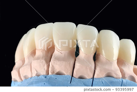 Natural look press ceramic veneers and crowns on dental plaster model. Close-up ceramic tooth crown. Dental prosthesis manufacturing workshop. Selective focus. Dental implant. Restoration of teeth 93395997