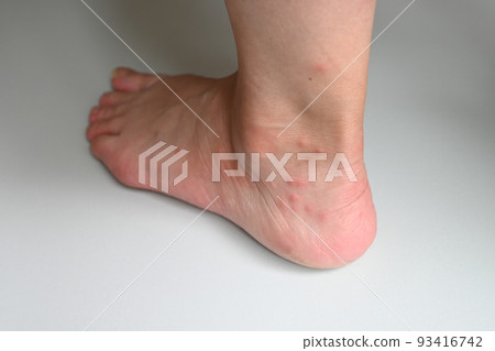 Foot insect bites 93416742