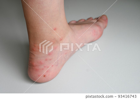 Foot insect bites 93416743
